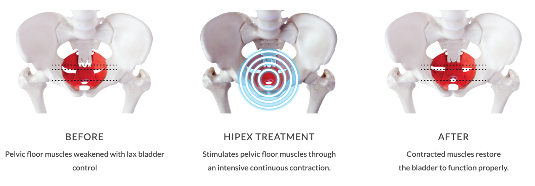 Urinary Incontinence Treatment Staffordshire 