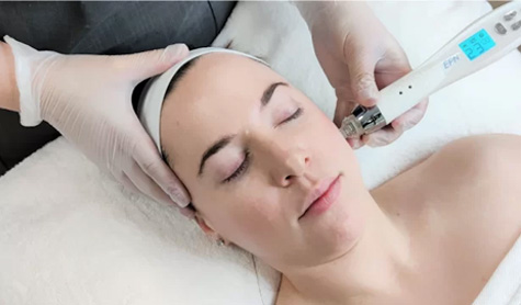 Microneedling for clear, healthy skin in Staffordshire